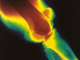 Buy Digitized X-Ray of Knee Patella Visible at AllPosters.com