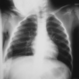 Buy Normal Chest X Ray 3 Year Old Child at AllPosters.com