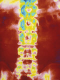 Buy Digitized Radiograph Pelvis Spine X-Ray at AllPosters.com