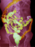 Xray Radiograph Abdomen Inject Contrast Intestines