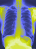 Normal Chest X-Ray with Spine and Ribs