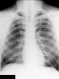 Buy Normal Adult Chest X-Ray at AllPosters.com