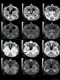 Buy CT Scan Brain Coronal Sect to Orbit and Sinuses at AllPosters.com