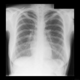 Buy Normal Adult Chest X-Ray at AllPosters.com