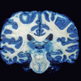 Brain, Coronal Section, Grey Matter Stained Blue