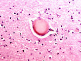 Buy Alzheimer's Disease Lipid Granule in a Human Brain at AllPosters.com
