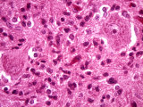 Buy Negri Bodies in the Brain Tissue of a Rabies Patient at AllPosters.com