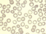 Normal Human Red Blood Cells or Erythrocytes in a Peripheral Blood Smear, Wright Stain