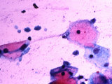 Trichomonas Vaginalis Protozoa in a Pap Smear