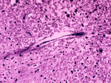 Buy Alzheimer's Brain with Neurofibrillary Tangles in the Cerebellum at AllPosters.com