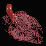 Resin Cast of Heart Showing Coronary Arteries