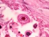 Cytomegalovirus with a Large Inclusion in the Nucleus of Lung Cells