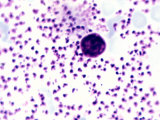 Leishmania Donovani Protozoa in a Liver Smear