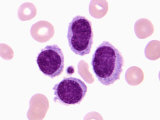 Hairy Cell Leukemia in a Human Blood Smear Showing Polymorphonuclear Leukocytes