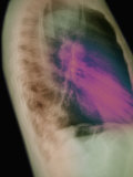 Lateral Chest X Ray of Lung Lower Lobe Pneumonia