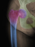 X Ray of a Subcapital Fracture of the Human Hip