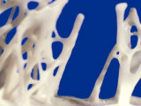 Spicules of Spongy or Cancellous Bone Femur