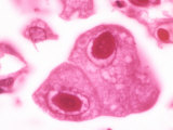 Cytomegalovirus with a Large Inclusion in the Nucleus of Lung Cells