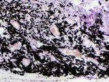 Buy Cross-Section of Lung Tissue from a Coal Miner Showing Large Quantities of Coal Dust at AllPosters.com