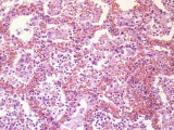 Edema of Human Lung Tissue