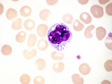 Human Monocyte Leukocyte or White Blood Cell Surrounded by Red Blood Cells