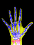 X-Ray of a Human Adult Hand