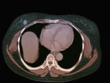 Right Human Breast Carcinoma Lesion Seen on an Abdomen Ct Scan