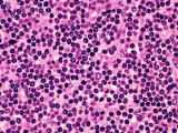 A Normal Human Lymph Node Showing Small, Dark Lymphocytes in the Cortex, H&E Stain
