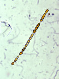 Buy Asbestos Fiber in a Human Lung at AllPosters.com