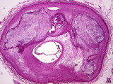 Right Coronary Artery with Severe Occlusive Change and Calcification, H&E Stain