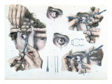 Buy Operation on a Strabismus, Plate from 'Traite Complet de l'Anatomie de l'Homme' at AllPosters.com