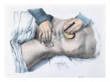 Buy Tying up an Artery, from 'Traite Complet de l'Anatomie de l'Homme' by Jean-Baptiste Marc Bourgery at AllPosters.com