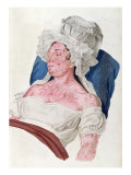 Woman with Scarlet Fever, from a Book by Baron Jean Louis Alibert