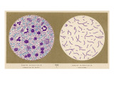 Bacillus of Bubonic Plague - Smear and Culture : Discovered by Yersin at Hong- Kong, 1894