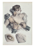 Buy Operating on a Cancerous Tumour at AllPosters.com