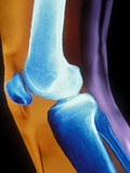 Buy Normal Human Knee Joint and Patella at AllPosters.com