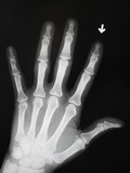 Hand Bones