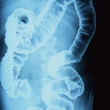 Buy X-Ray of Intestines at AllPosters.com