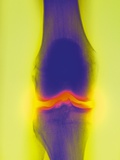 Buy Joint X Ray at AllPosters.com