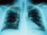Buy X-Ray of Dark Lungs at AllPosters.com