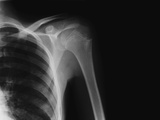Buy X-ray of a Shoulder at AllPosters.com