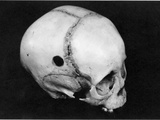 Trepanning: Skull