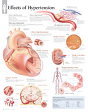 Effects of Hypertension Educational Blood Pressure Chart Poster Poster