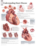 Laminated Understanding Heart Disease Educational Chart Poster