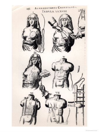 Operating on Breast Cancer, from "Armamentarii Chirurgici" Giclee Print Operating on Breast Cancer, from "Armamentarii Chirurgici" Giclee Print