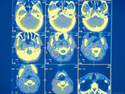 Ct+scan+images+of+brain