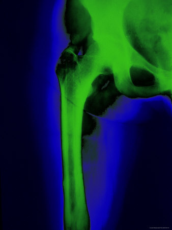 Anteroposterior x-ray of the proximal femur after fixation of the femoral