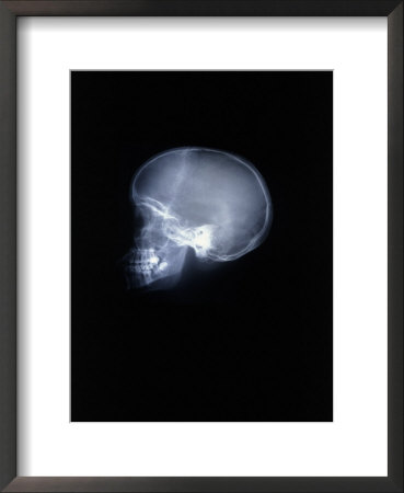 X-ray of skull Framed Print X-ray of skull Framed Print