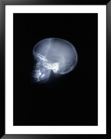 X-ray of skull Framed Print X-ray of skull Framed Print