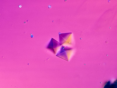 amorphous urate crystals in urine. Calcium+oxalate+crystals+